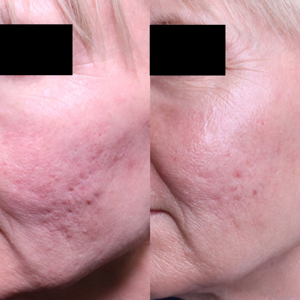 Understanding and Treating Warts A Comprehensive Guide