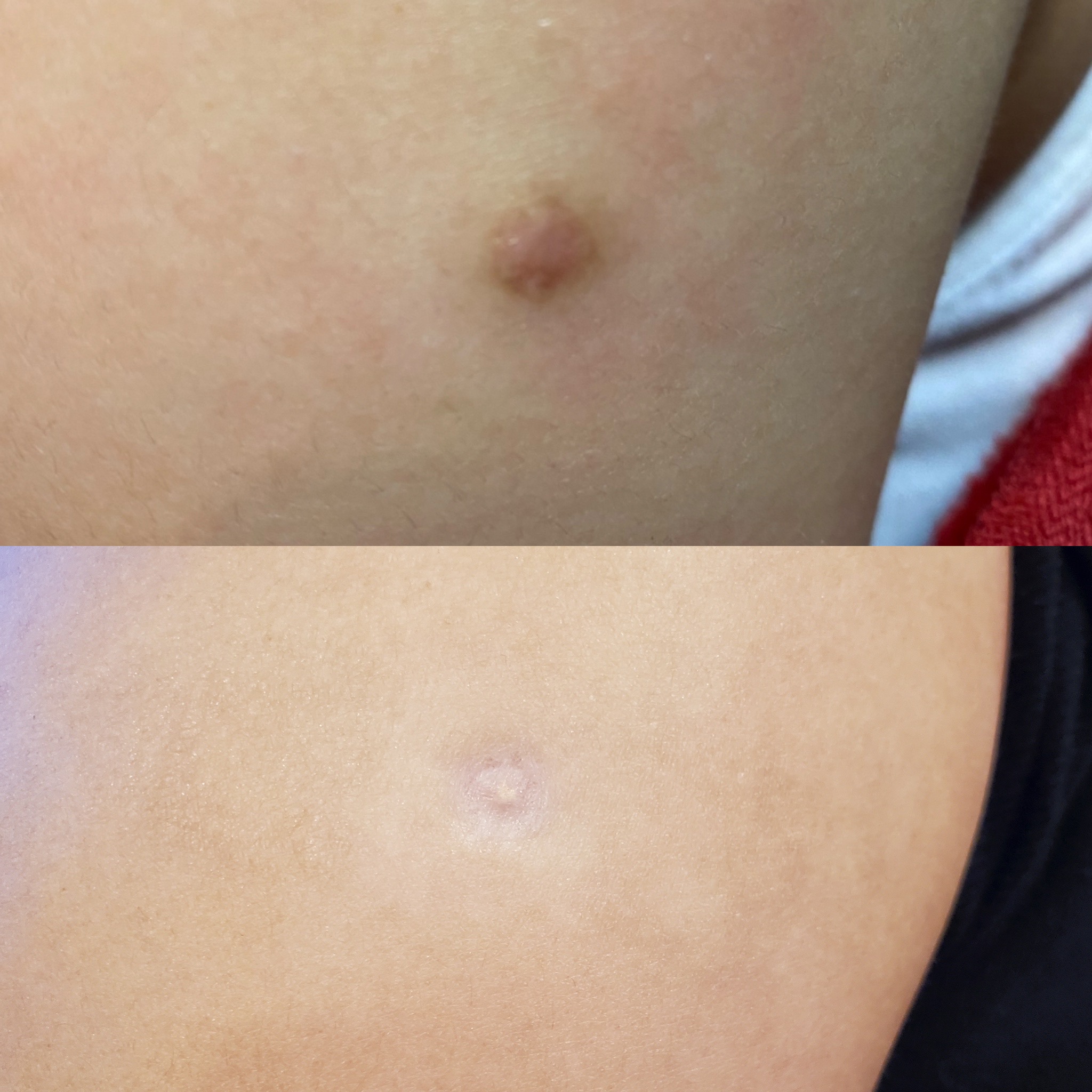 Scar treatment before and after images
