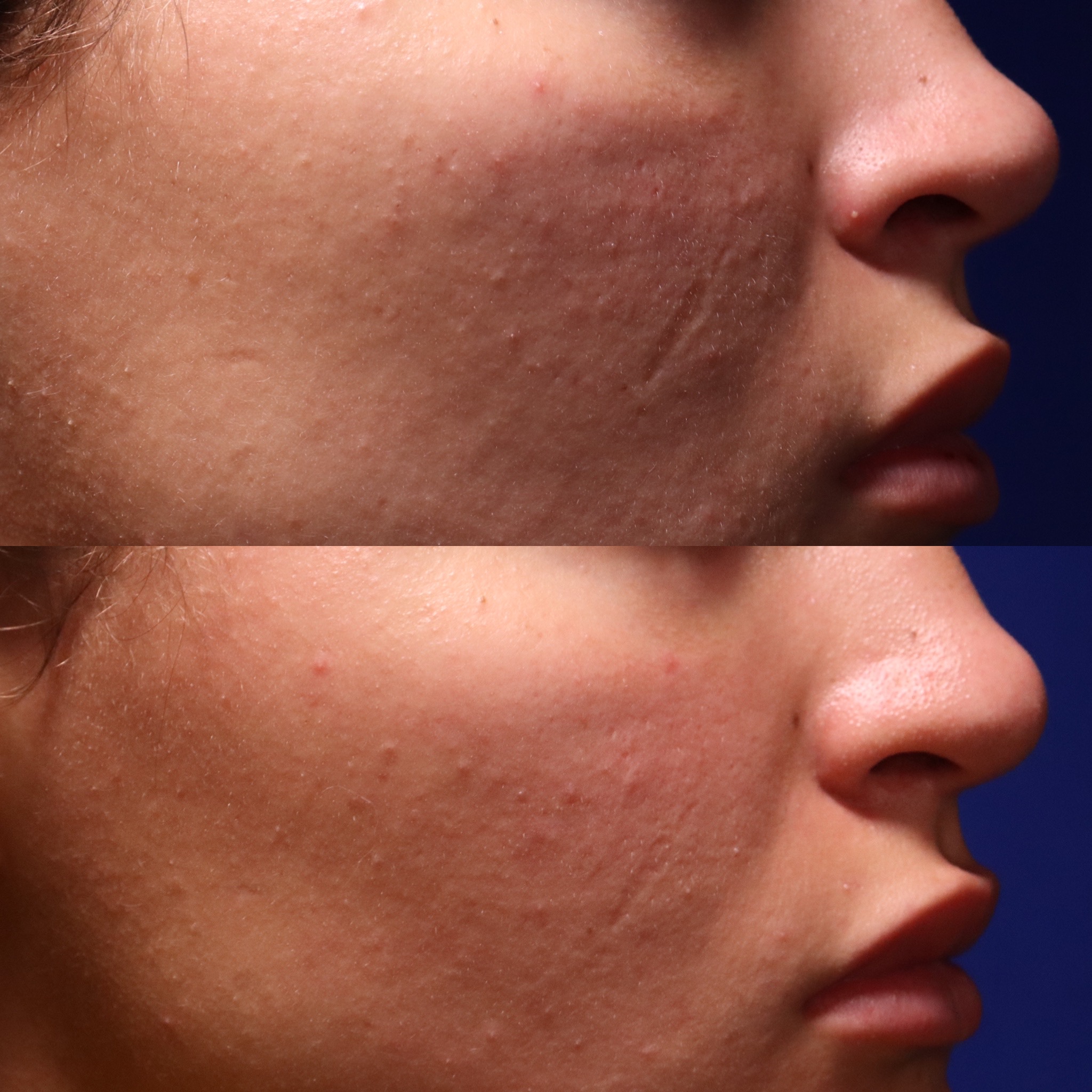Scar treatment before and after