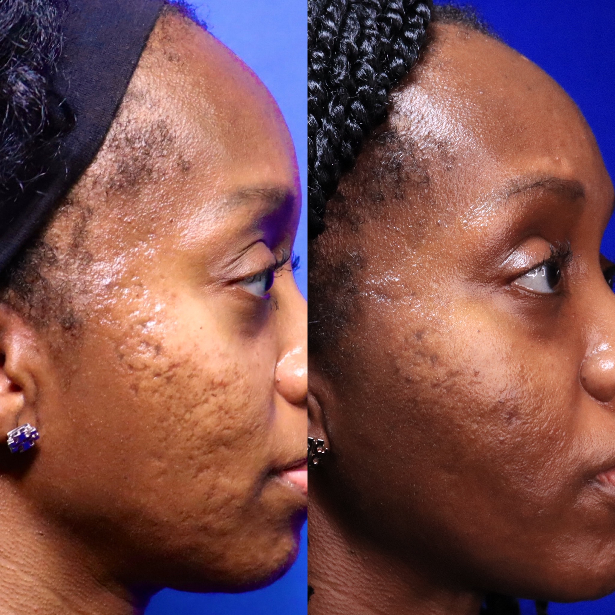 Black Skin Acne Scar Before and After