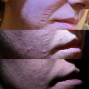 Acne scar traetment before and after