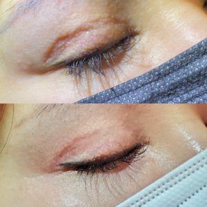 Scar treatment before and after images