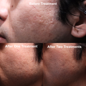 Scar treatment before and after