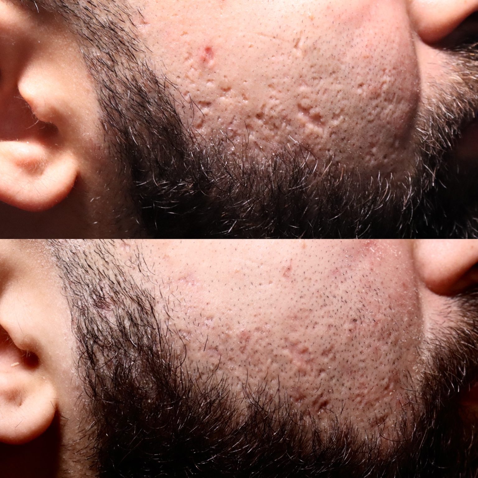 How to Trust a Scar Center + Photography for Acne Scarring