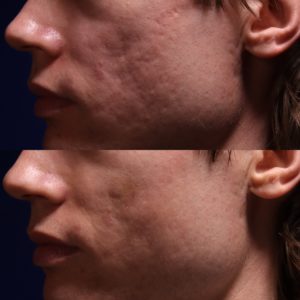 Acne scar traetment before and after