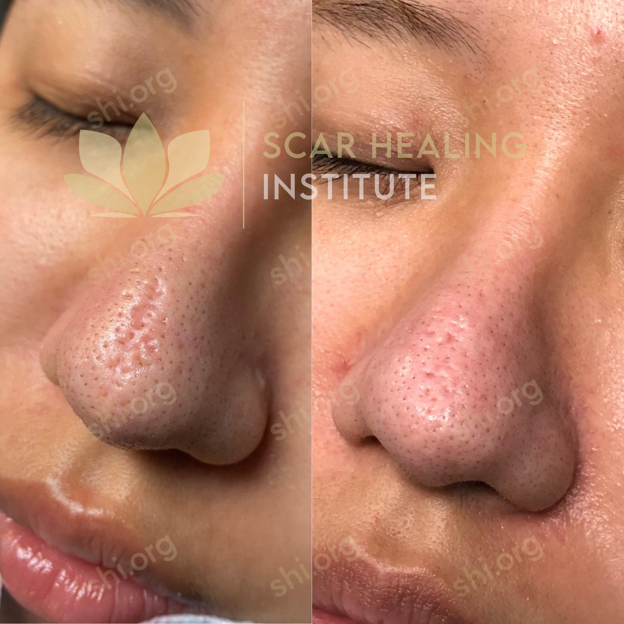 Acne scarring before and after photo