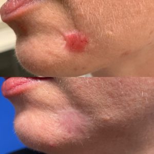 Scar treatment before and after skin scars