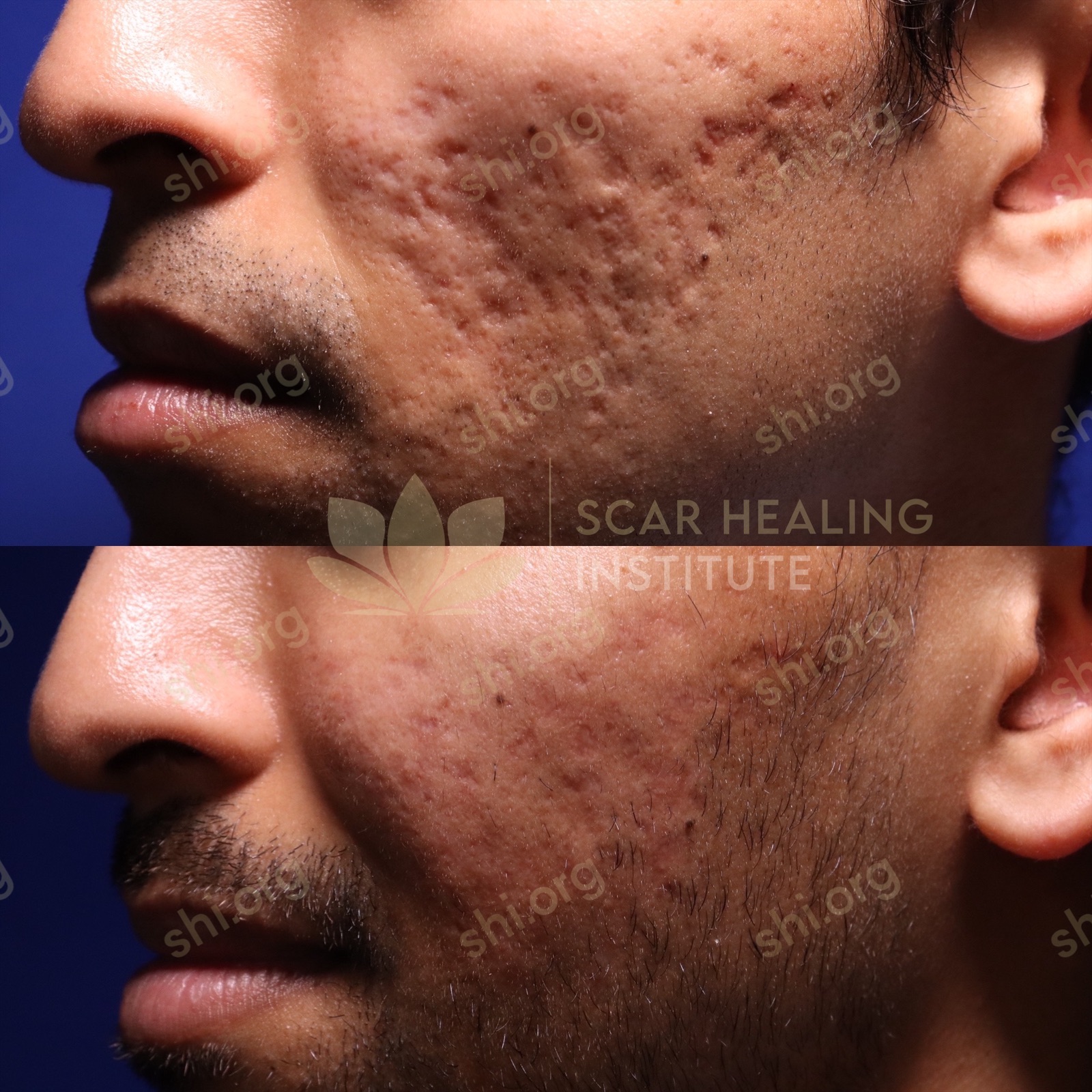 Acne scarring before and after photo