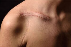 Scar Healing Institute SHI Scar Removal Center Los Angeles California Wound Healing