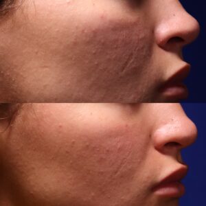 SH SHI 45 Non Acne Scarring Active Acne Patient Results