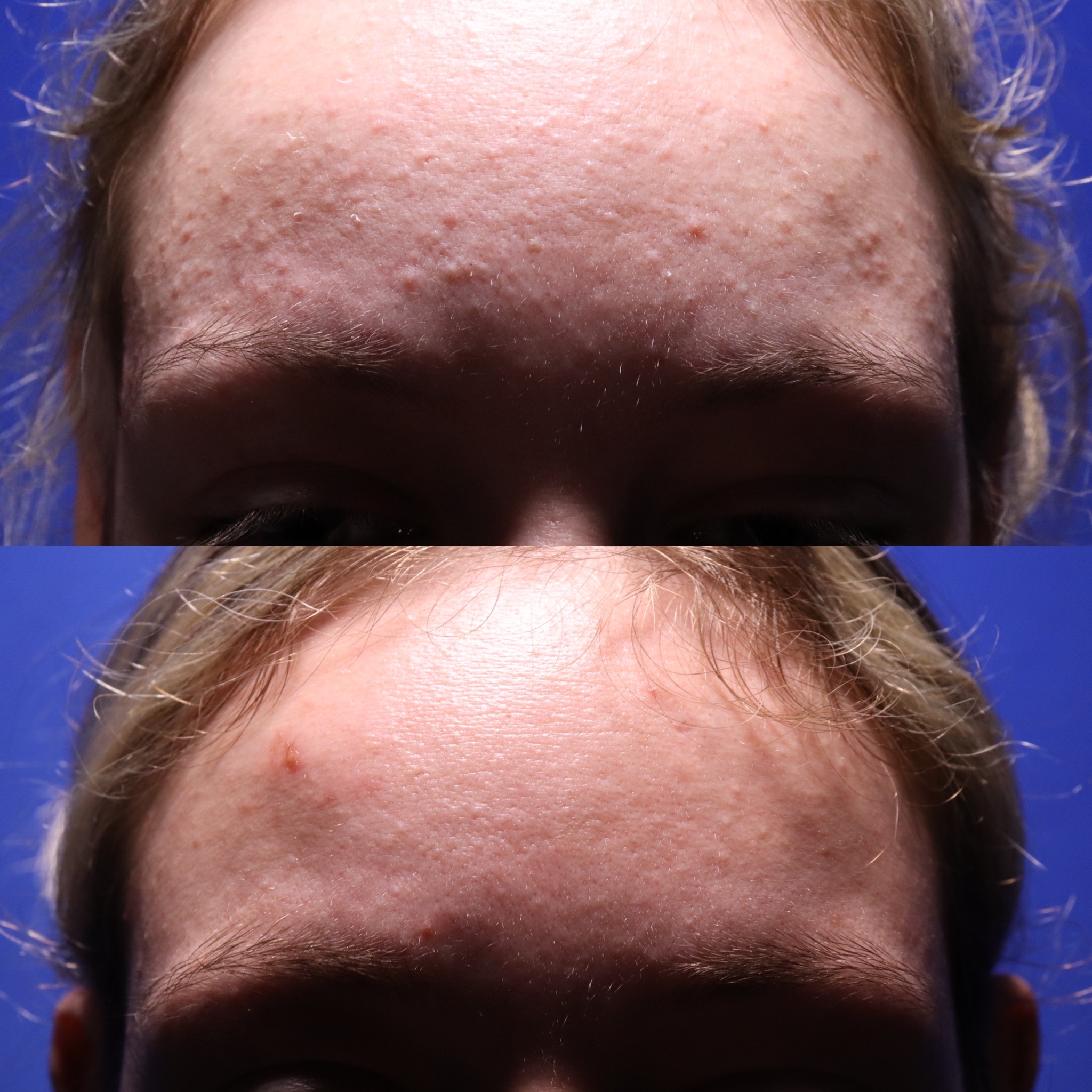 BB, SHI 4 Non Acne Scarring Active Acne Patient Results