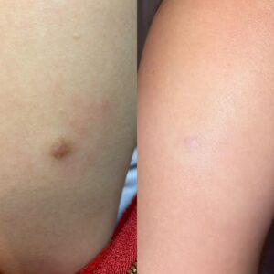 IA SHI 15 Non Acne Scarring Active Acne Patient Results