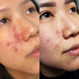 JC SHI 19 Non Acne Scarring Active Acne Patient Results