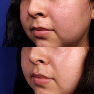 SR SHI 66 Non Acne Scarring Active Acne Patient Results