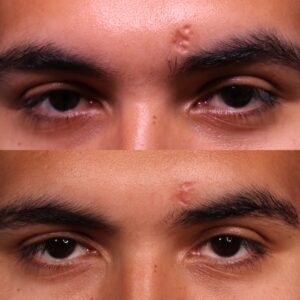 OC SHI 38 Non Acne Scarring Active Acne Patient Results
