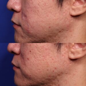 AY SHI 6 Non Acne Scarring Active Acne Patient Results