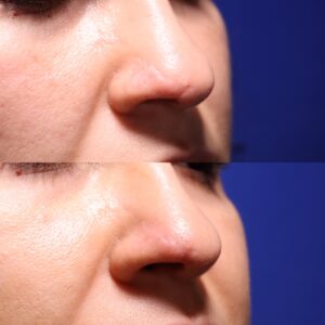 JM SHI 21 Non Acne Scarring Active Acne Patient Results