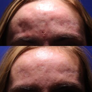 MH SHI 33 Non Acne Scarring Active Acne Patient Results