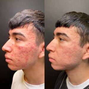 AL SHI 1 - Non Acne Scarring Active Acne Patient Results