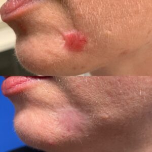 LS SHI 27 - Non Acne Scarring Active Acne Patient Results Scar Healing