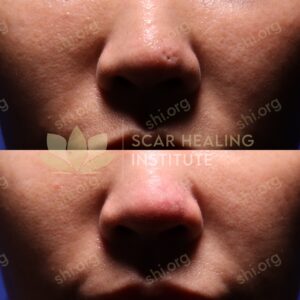 IC SHI 57 - Acne Scarring Active Acne Patient Results Scar Healing