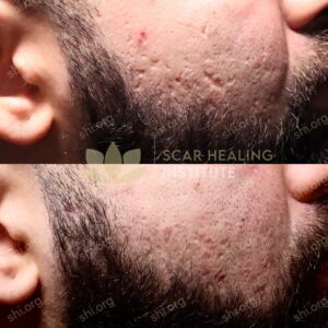 JJ SHI 17 - Acne Scarring Active Acne Patient Results Scar Healing