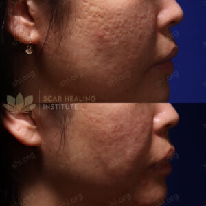 LS SHI 28 - Acne Scarring Active Acne Patient Results Scar Healing