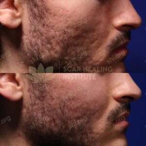 RM SHI 55 - Acne Scarring Active Acne Patient Results Scar Healing