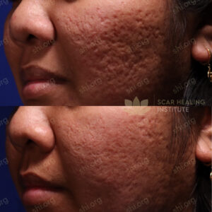 RS SHI 67 - Acne Scarring Active Acne Patient Results Scar Healing