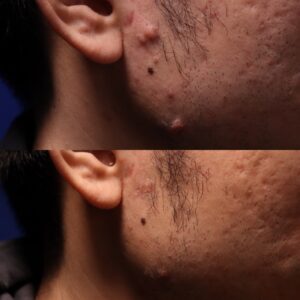 ZH SHI 50 - Non Acne Scarring Active Acne Patient Results Scar Healing