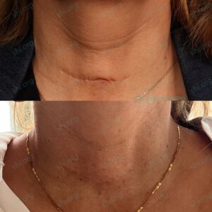 CD SHI 73 - Non Acne Scarring Active Acne Patient Results Scar Healing