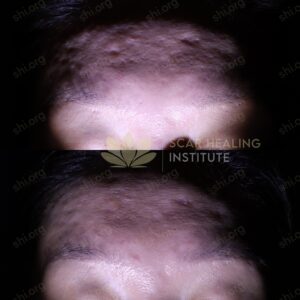 JY SHI 16 - Acne Scarring Active Acne Patient Results Scar Healing