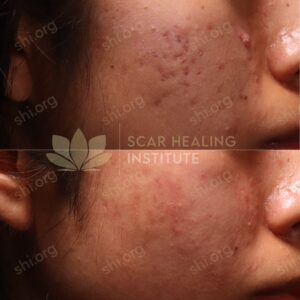 TC SHI 56 - Acne Scarring Active Acne Patient Results Scar Healing