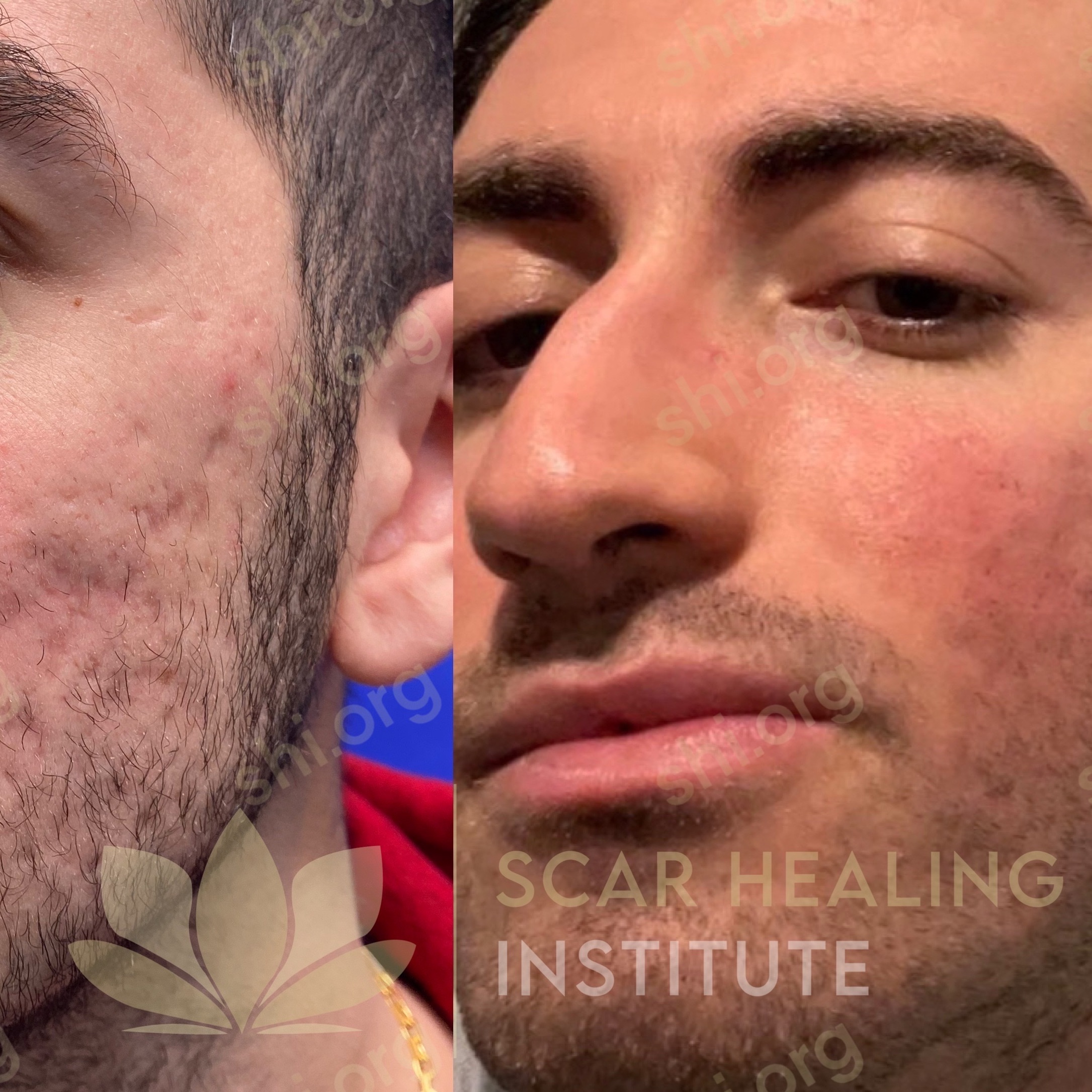 AB SHI 2 - Acne Scarring Active Acne Patient Results Scar Healing