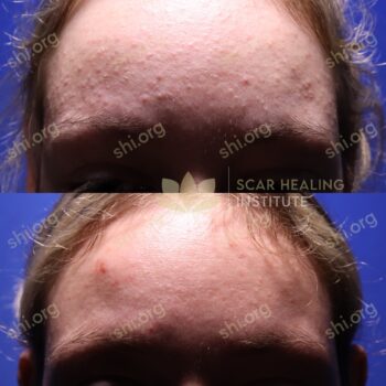 AL SHI Patient 4 After Active Acne Treatments at Scar Healing Institute