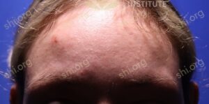 AL SHI Patient 4 After Active Acne Treatments at Scar Healing Institute