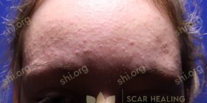 AL SHI Patient 4 Before After Active Acne Treatments at Scar Healing Institute