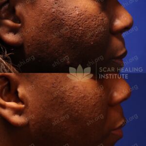 BB SHI 5 - Acne Scarring Active Acne Patient Results Scar Healing