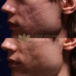 BP SHI 3 - Acne Scarring Active Acne Patient Results Scar Healing