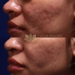 CP SHI 61 - Acne Scarring Active Acne Patient Results Scar Healing