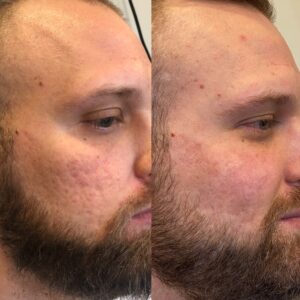 DM SHI 59 - Acne Scarring Active Acne Patient Results Scar Healing