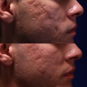 JDP SHI 22 - Acne Scarring Active Acne Patient Results Scar Healing