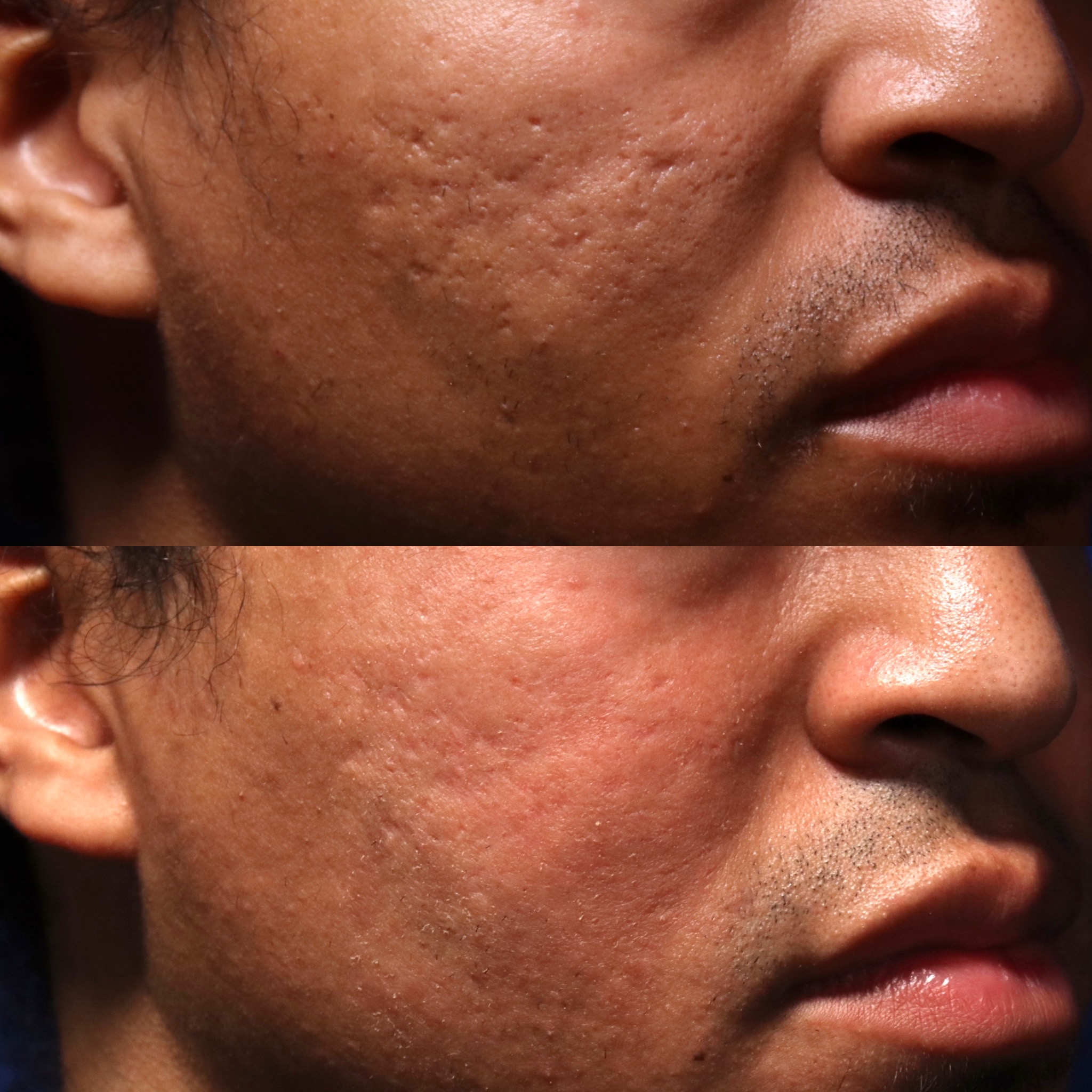 AP SHI 88 - Acne Scarring Active Acne Patient Results Scar Healing