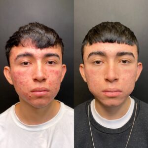 AL SHI Patient 1 Before and After Active Acne Treatments at Scar Healing Institute Frontal View