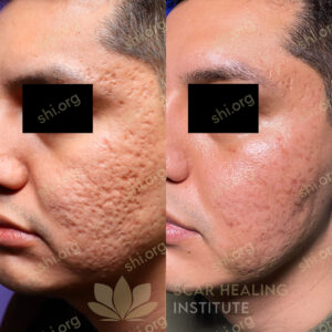 DD SHI 7 - Acne Scarring Active Acne Patient Results Scar Healing