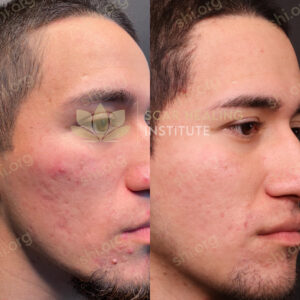 DT SHI 8 - Acne Scarring Active Acne Patient Results Scar Healing