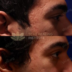 EA SHI 9 - Acne Scarring Active Acne Patient Results Scar Healing
