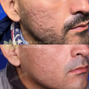 JD SHI 23 - Acne Scarring Active Acne Patient Results Scar Healing