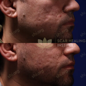 JK SHI 20 - Acne Scarring Active Acne Patient Results Scar Healing