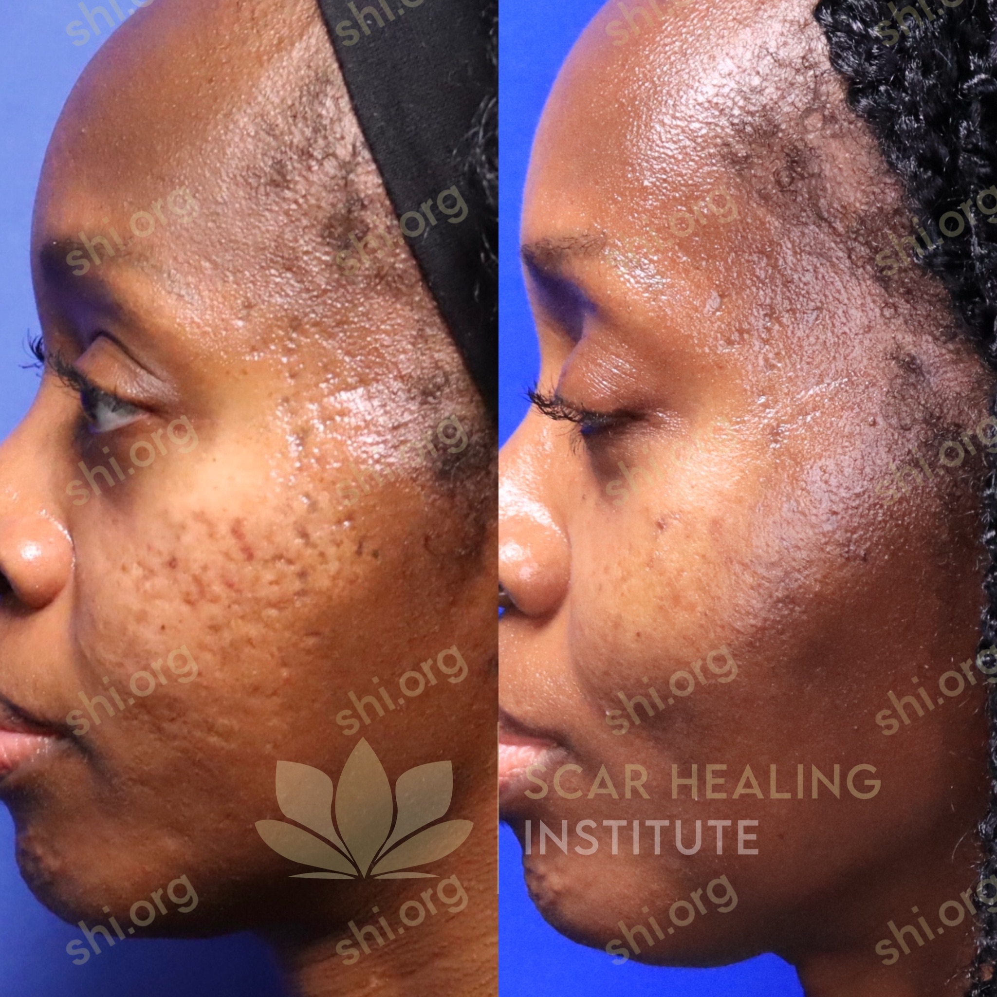LJ SHI 29 - Acne Scarring Active Acne Patient Results Scar Healing
